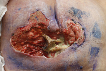 ulcer on the sacrum - bedsore II degree. Pressure Ulcers