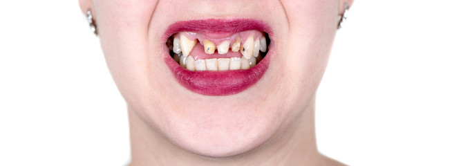 Smile of woman without front teeth - obrazy, fototapety, plakaty