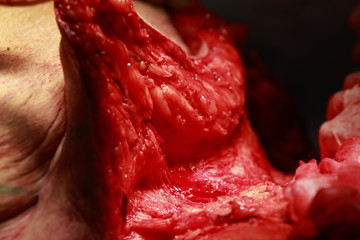Excess subcutaneous fat close-up