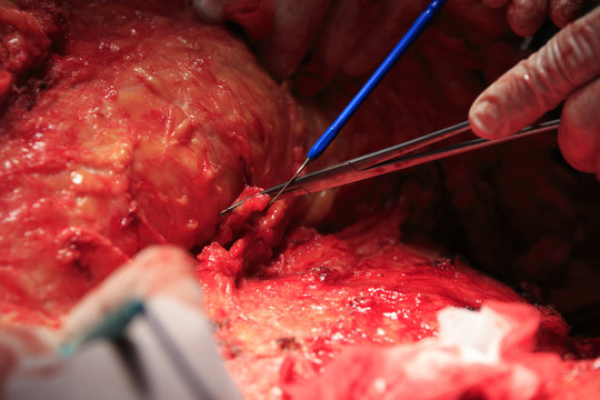 Cauterizing with surgical tools during the surgery close-up