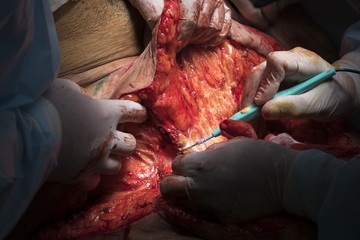 Surgery close-up of removal excess fat and skin with coagulator