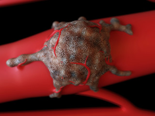 medically accurate 3d illustration of a tumor