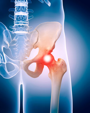 medically accurate 3d illustration of the painful hip