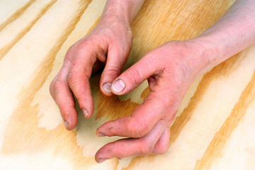 Arthritis of the hands
