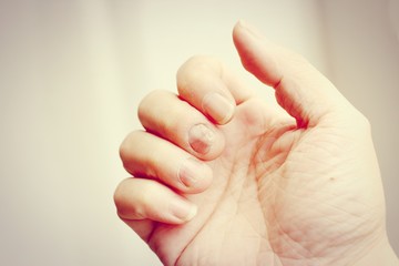 Fungus Infection on Nails Hand, Finger with onychomycosis. - soft focus,