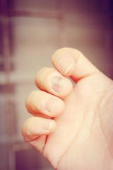 Fungus Infection on Nails Hand, Finger with onychomycosis. - sof