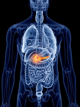 3d rendered, medically accurate illustration of pancreas cancer