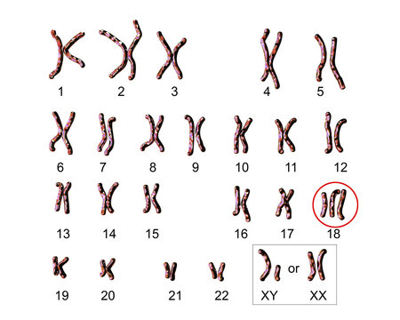 Edwards-syndrome karyotype, labeled. Trisomy 18. 3D illustration