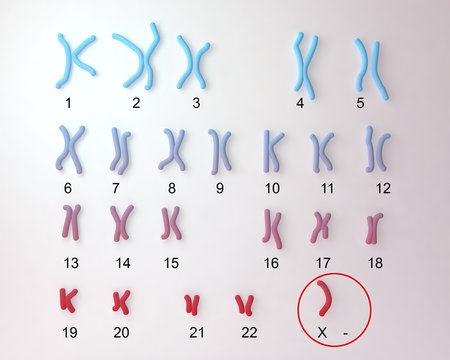 Turner&rsquo;s-syndrome karyotype, labeled. X0 karyotype. 3D illustration