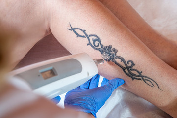 tattoo removal / laser tattoo removal from leg