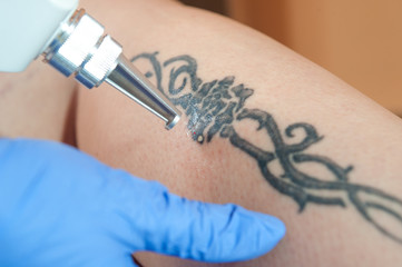tattoo removal / laser tattoo removal from leg