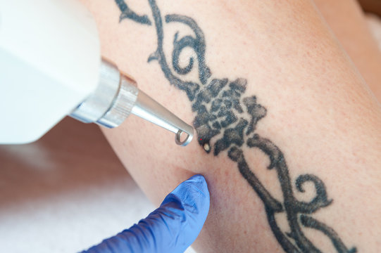 tattoo removal / laser tattoo removal from leg