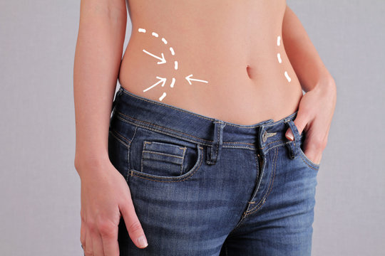 Woman weight loss, liposuction concept. Woman body with belly fat and correction Lines / Arrows