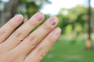 Fototapeta na wymiar Finger with onychomycosis. A toenail fungus.. - soft focus
