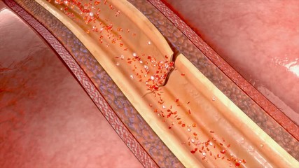 Coronary artery dissection