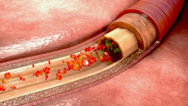 Antiplatelet therapy