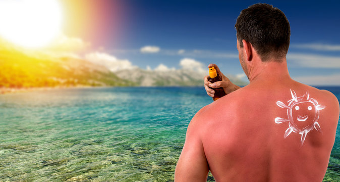 Man with sunburned skin