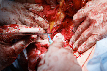 Cauterize close-up with forceps and cloagulator with many surgeon's hands covered in blood and open...