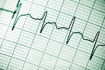 Electrocardiogram