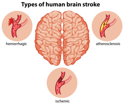 Types of human brain stroke
