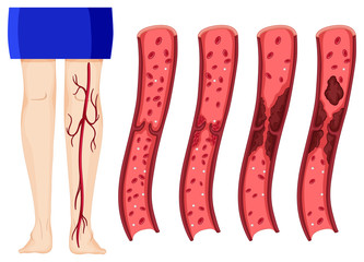 Blood clot in human legs