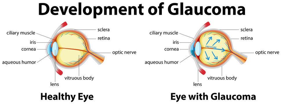 Development of Glaucoma in human eyes
