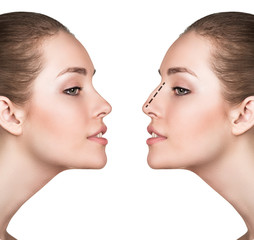 Woman before and after cosmetic nose surgery