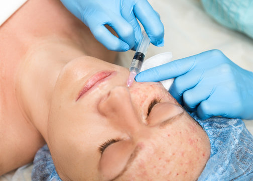Beautician makes biorevitalization to young woman. The cosmetic procedures for the face. Beauty treatments in the spa salon. Facial Skin Care