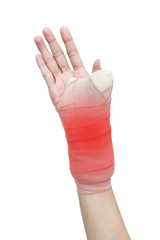 broken woman arm in a cast