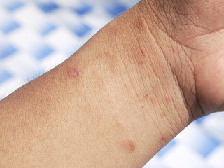 Fototapeta premium arm wound