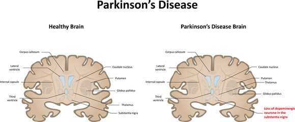Parkinson's Disease