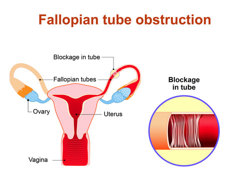 Fallopian Tube Obstruction