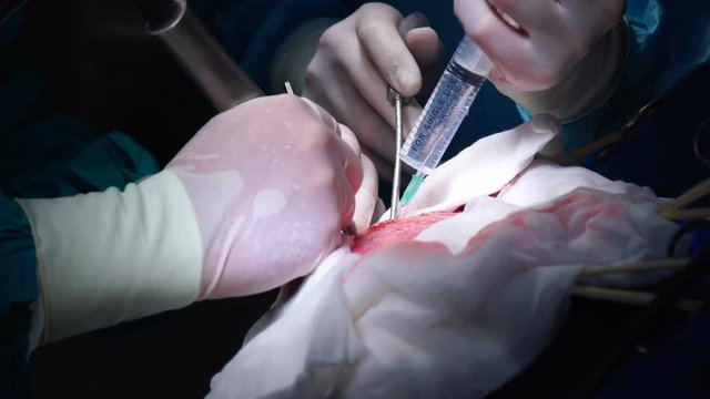 Close-up of the Surgeon's Hands and Instruments in the background of the Skull.The operation of Craniotomy in the Hospital