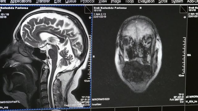  Doctor working with MRI images on a computer