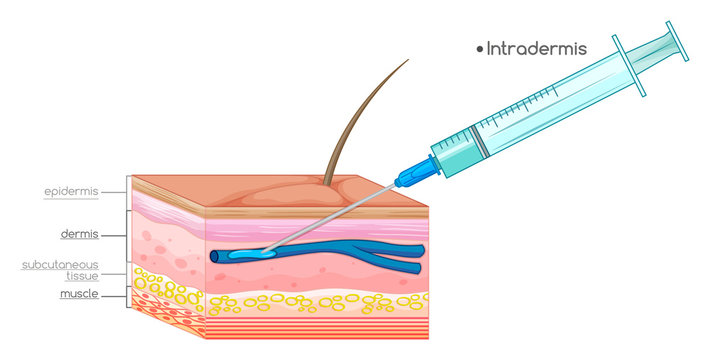 Diagram showing needle injection on skin