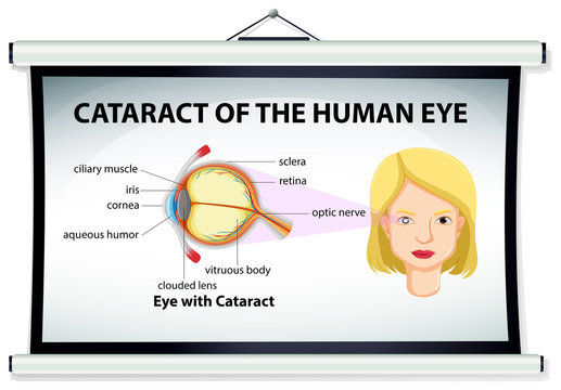 Chart showing cataract of human eye