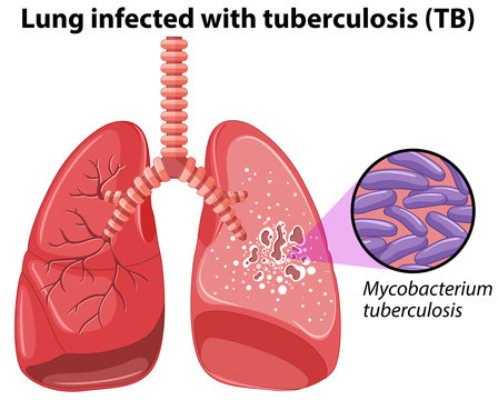 Lung infected with tuberculosis