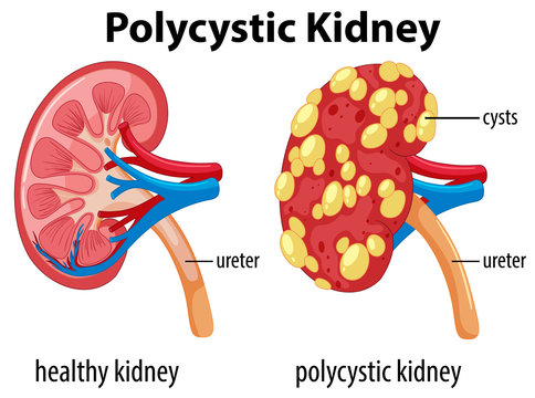 Diagram Showing Polycystic Kidney