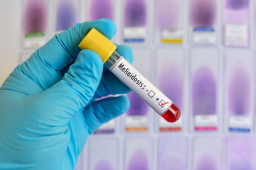 Melioidosis positive

