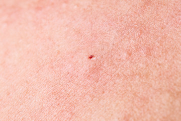 eczema atopic dermatitis symptom skin,cause of itchy scar detail