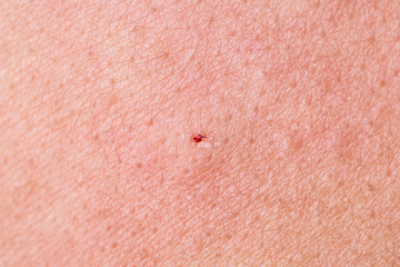eczema atopic dermatitis symptom skin,cause of itchy scar detail
