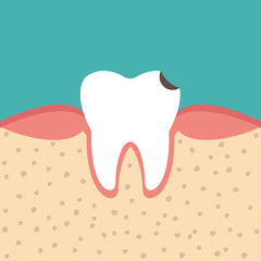 tooth sectional view tooth decay