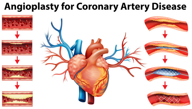 Diagram showing angioplasty for coronary artery disease