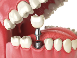 Tooth human implant. Dental concept. Human teeth or dentures. - obrazy, fototapety, plakaty