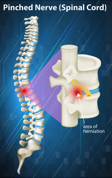 Diagram Of Pinched Nerve At Spinal Cord