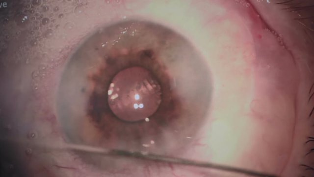 Eye surgery. Cataract removal surgery. Close up 1080p