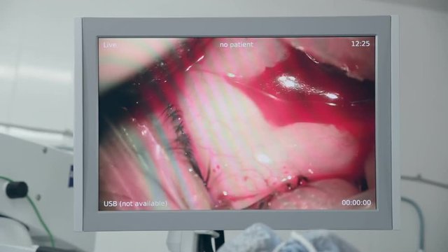 Eye surgery. Cataract removal surgery. Close up 1080p