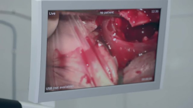 Eye surgery. Cataract removal surgery. Close up 1080p