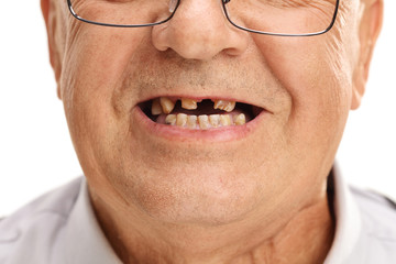 Mouth of a senior with broken teeth