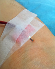 needle stuck in the arm when donating blood